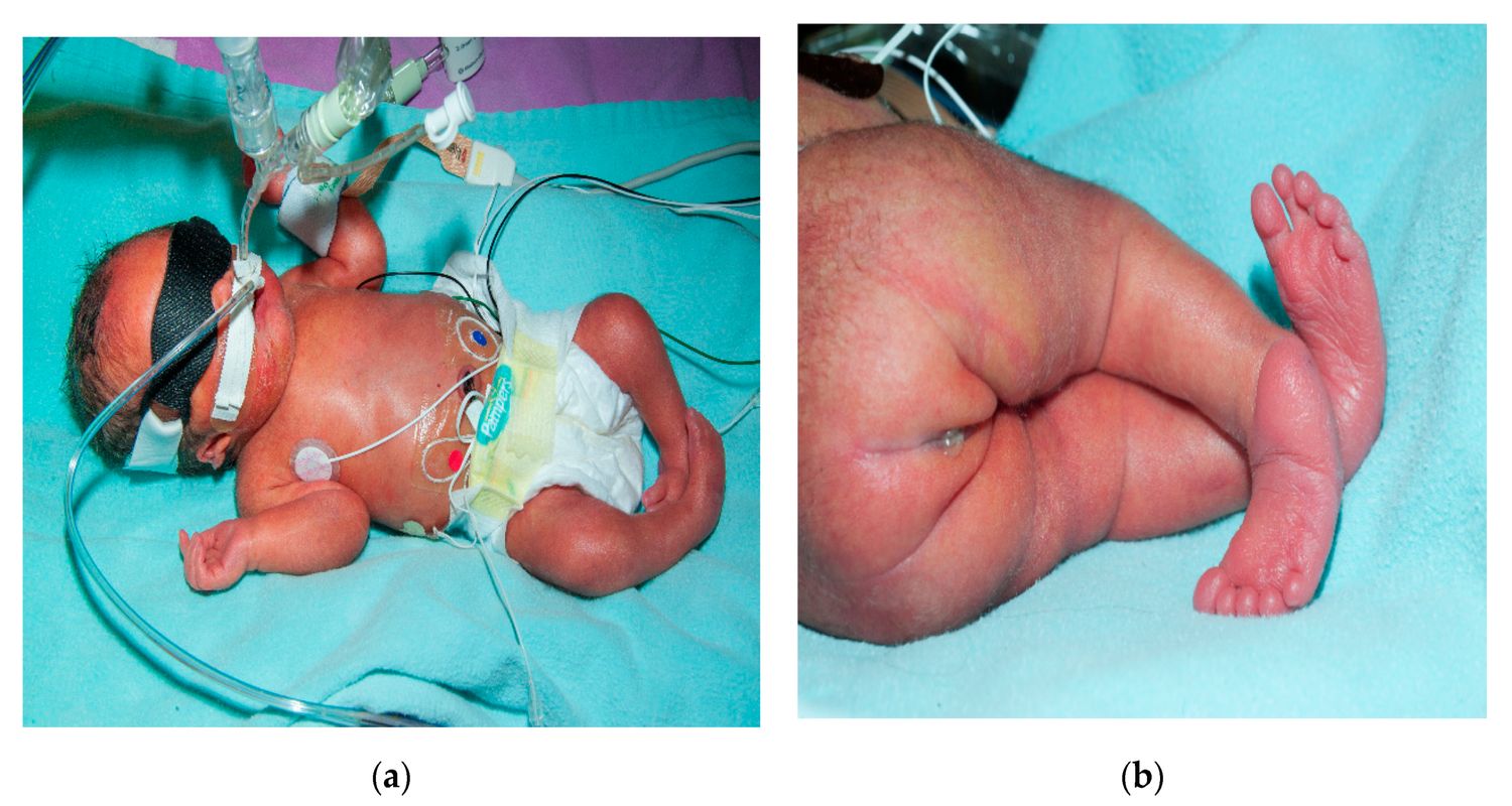 25-facts-about-renal-dysplasia-megalocystis-sirenomelia