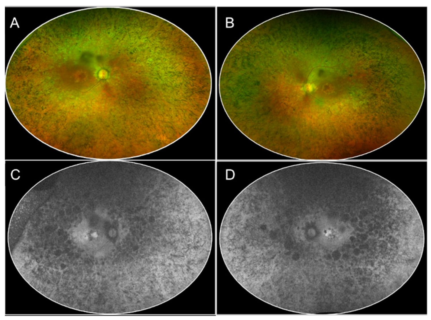 25-facts-about-retinal-dysplasia-x-linked