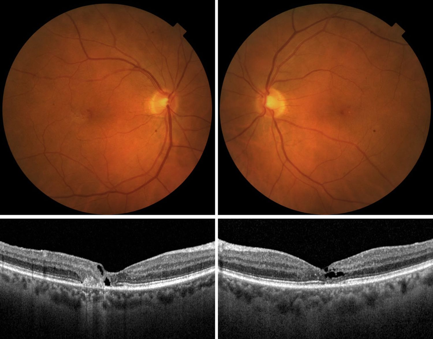 25-facts-about-retinal-telangiectasia-hypogammaglobulinemia