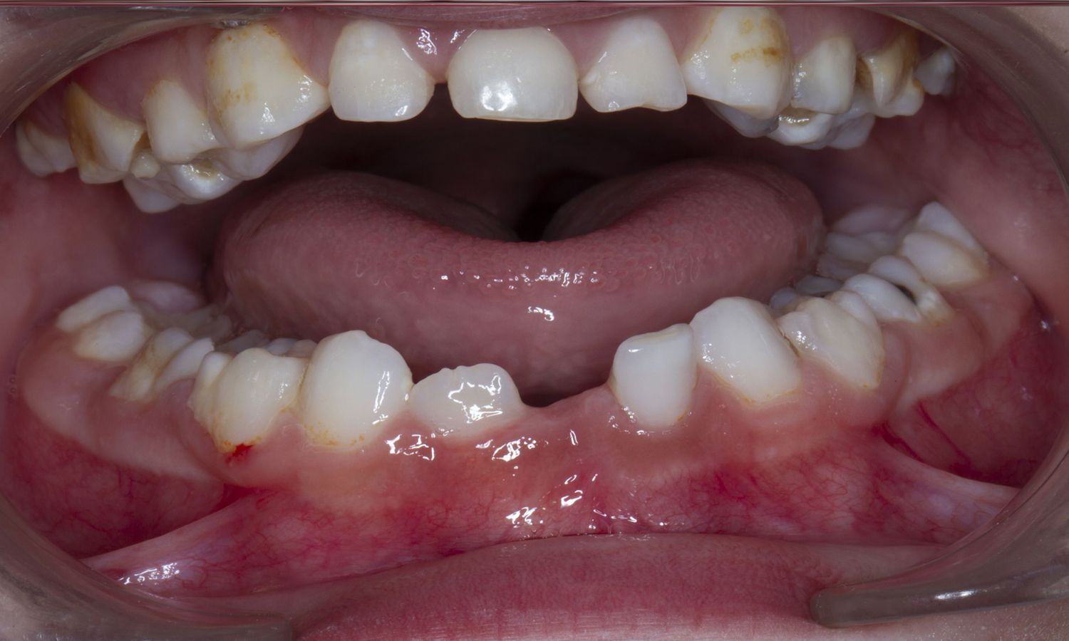 25-facts-about-single-upper-central-incisor