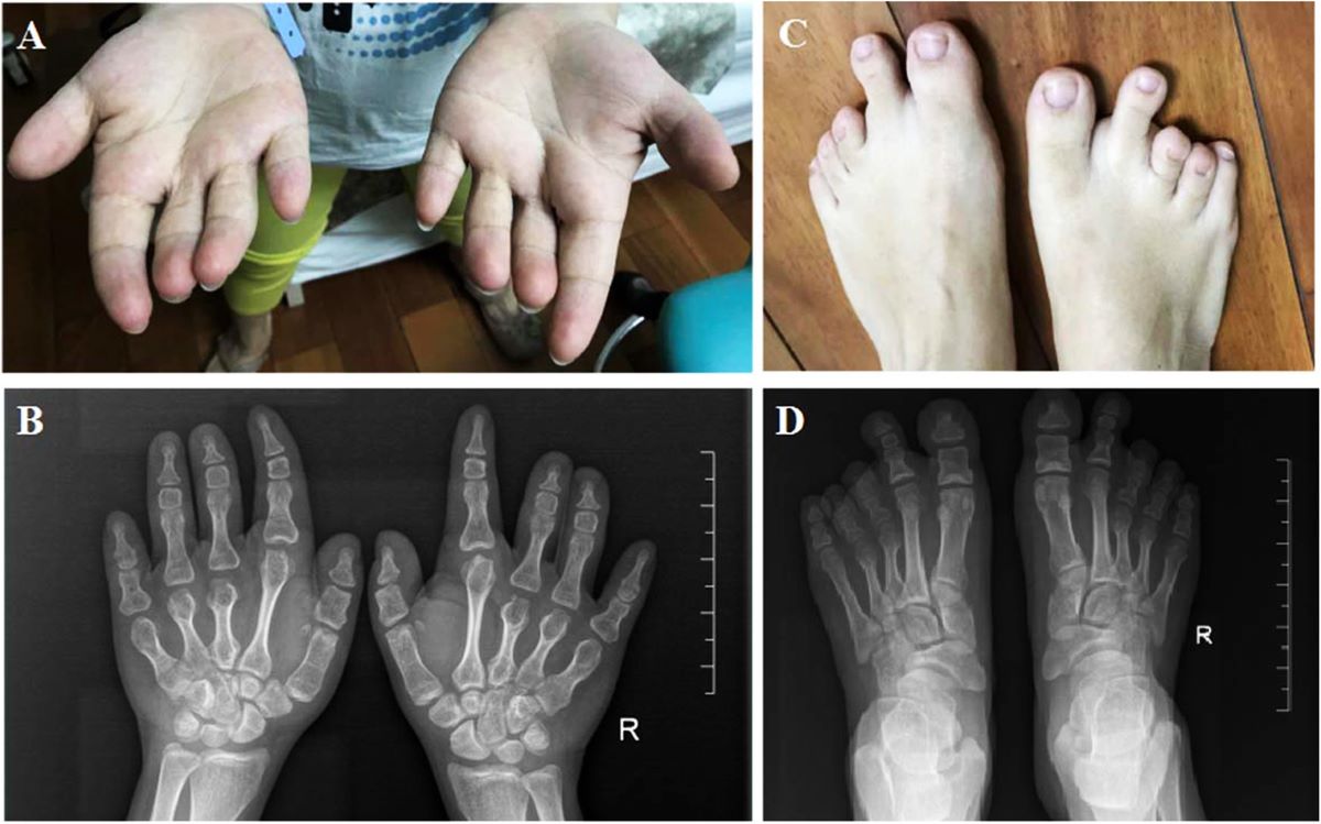 25-facts-about-skeletal-dysplasia-brachydactyly