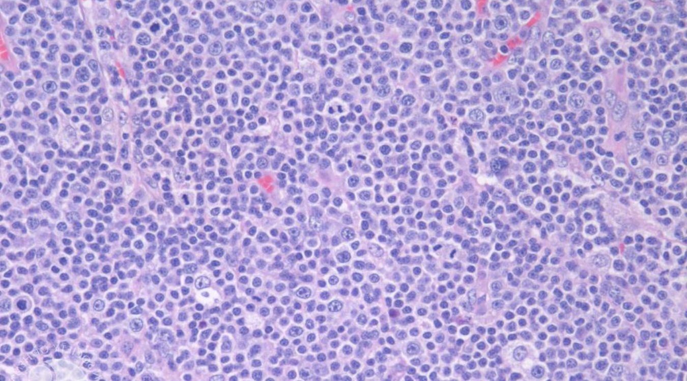 25-facts-about-small-uncloven-cell-lymphoma