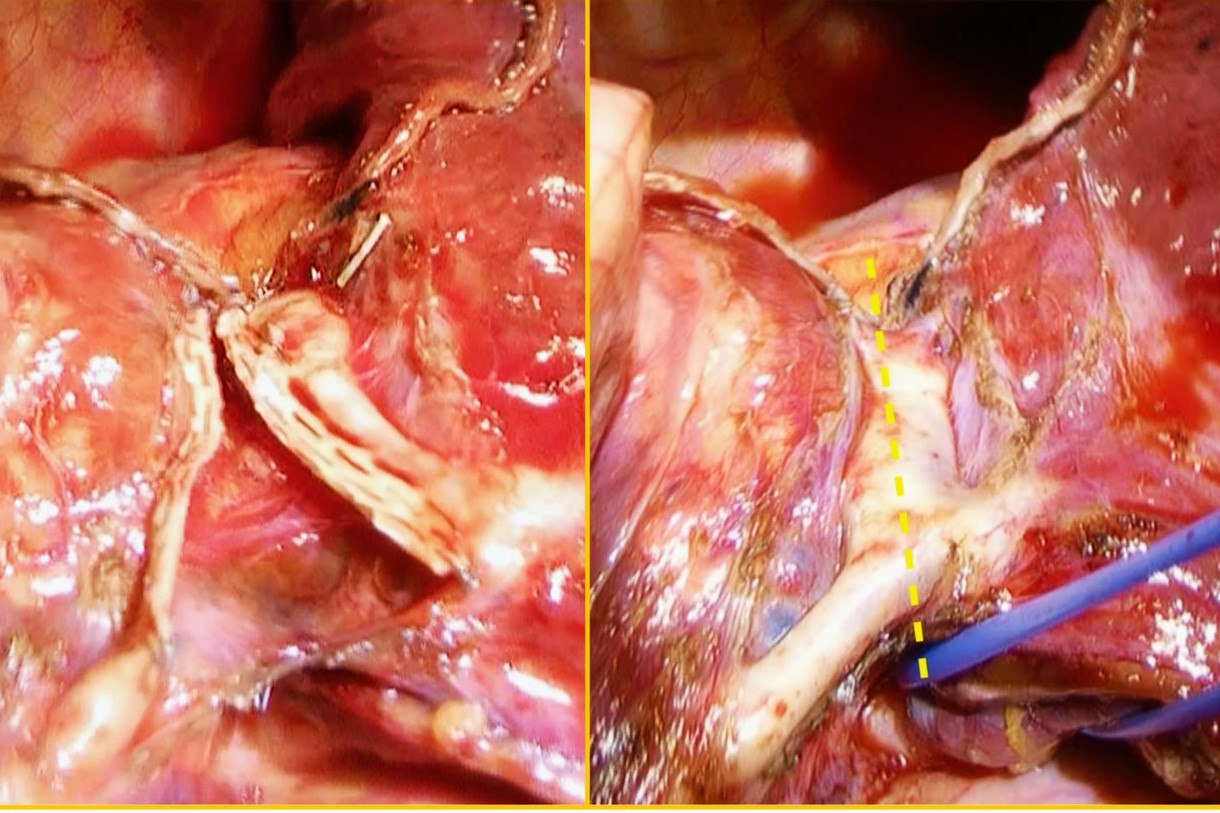 25-facts-about-systemic-arterio-veinous-fistula