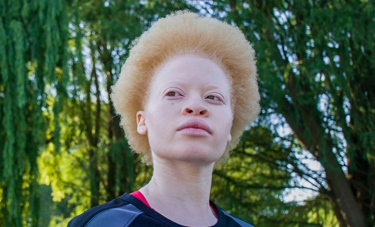 25 Facts About Tyrosinase positive Oculocutaneous Albinism OCA2 