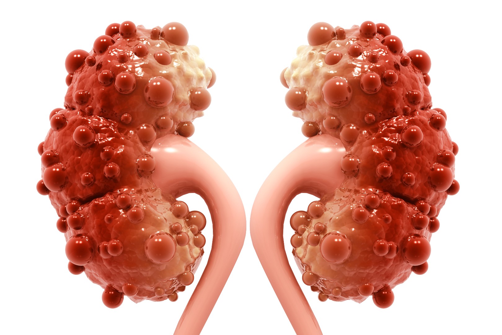 30-facts-about-adult-polycystic-kidney-disease-apckd