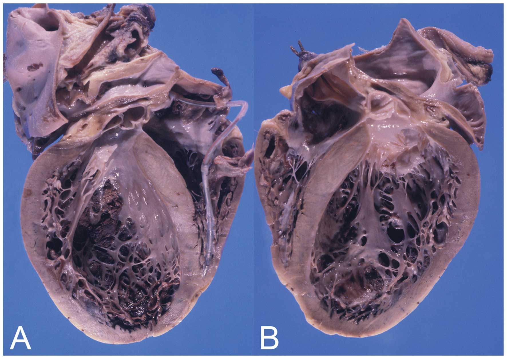 30-facts-about-hypogonadism-cardiomyopathy