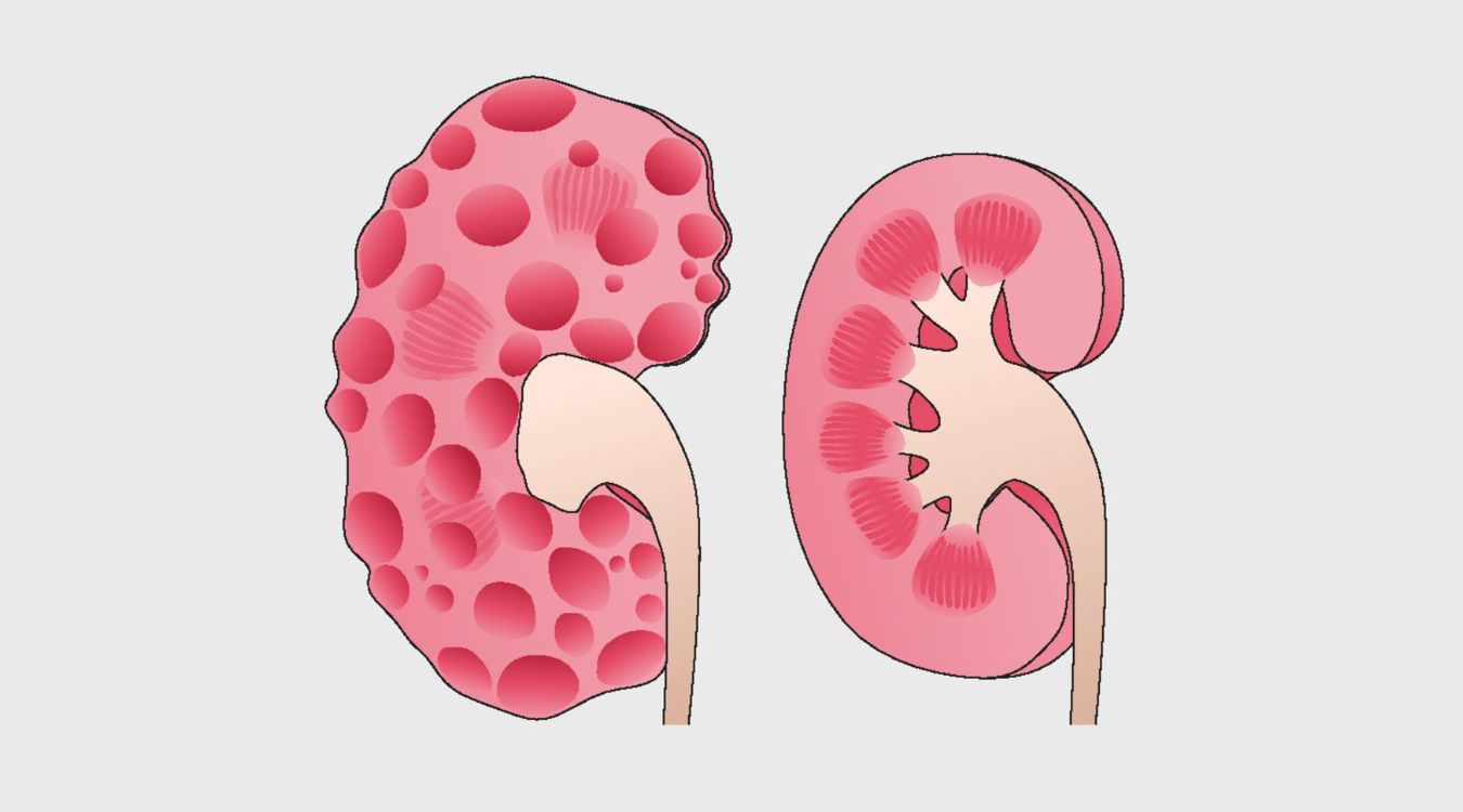 30-facts-about-infantile-polycystic-kidney-disease-ipkd