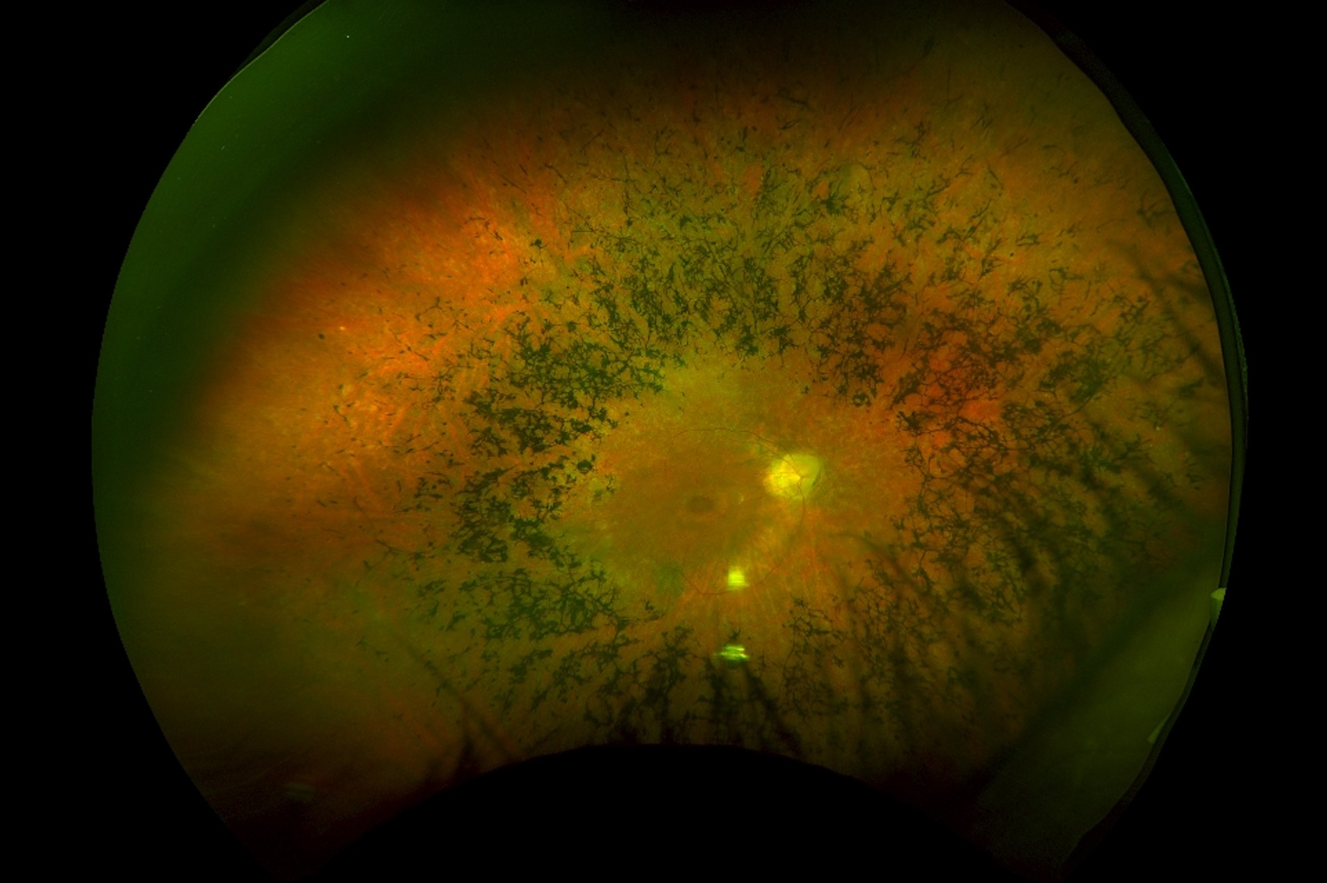 30-facts-about-muscular-atrophy-ataxia-retinitis-pigmentosa-diabetes-mellitus