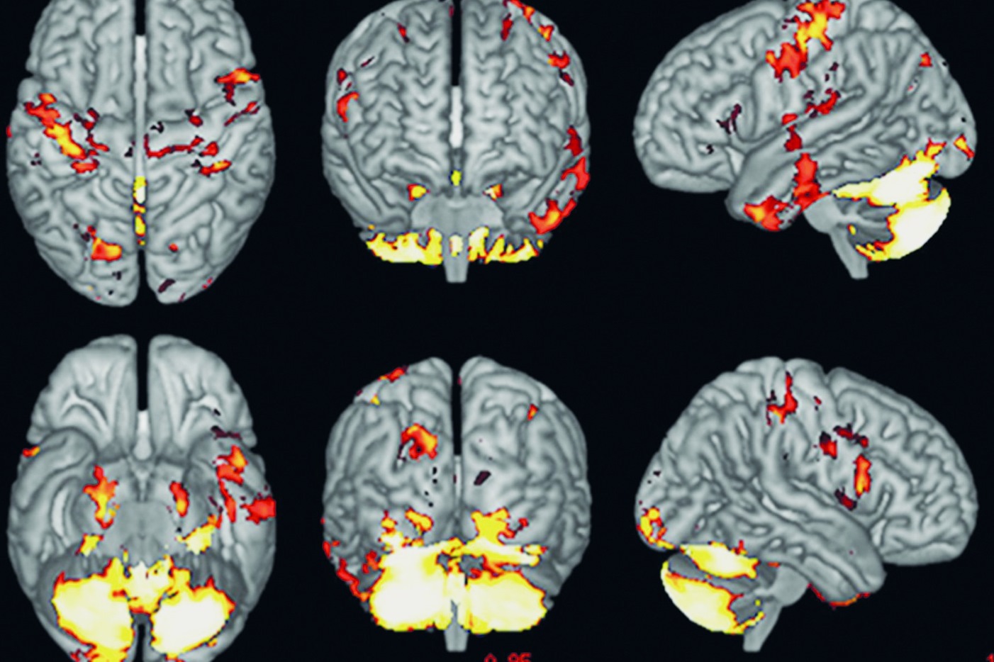 30-facts-about-muscular-dystrophy-white-matter-spongiosis