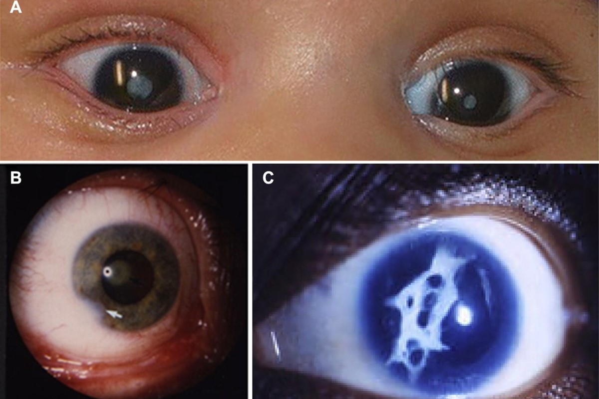 30-facts-about-myopathy-cataract-hypogonadism