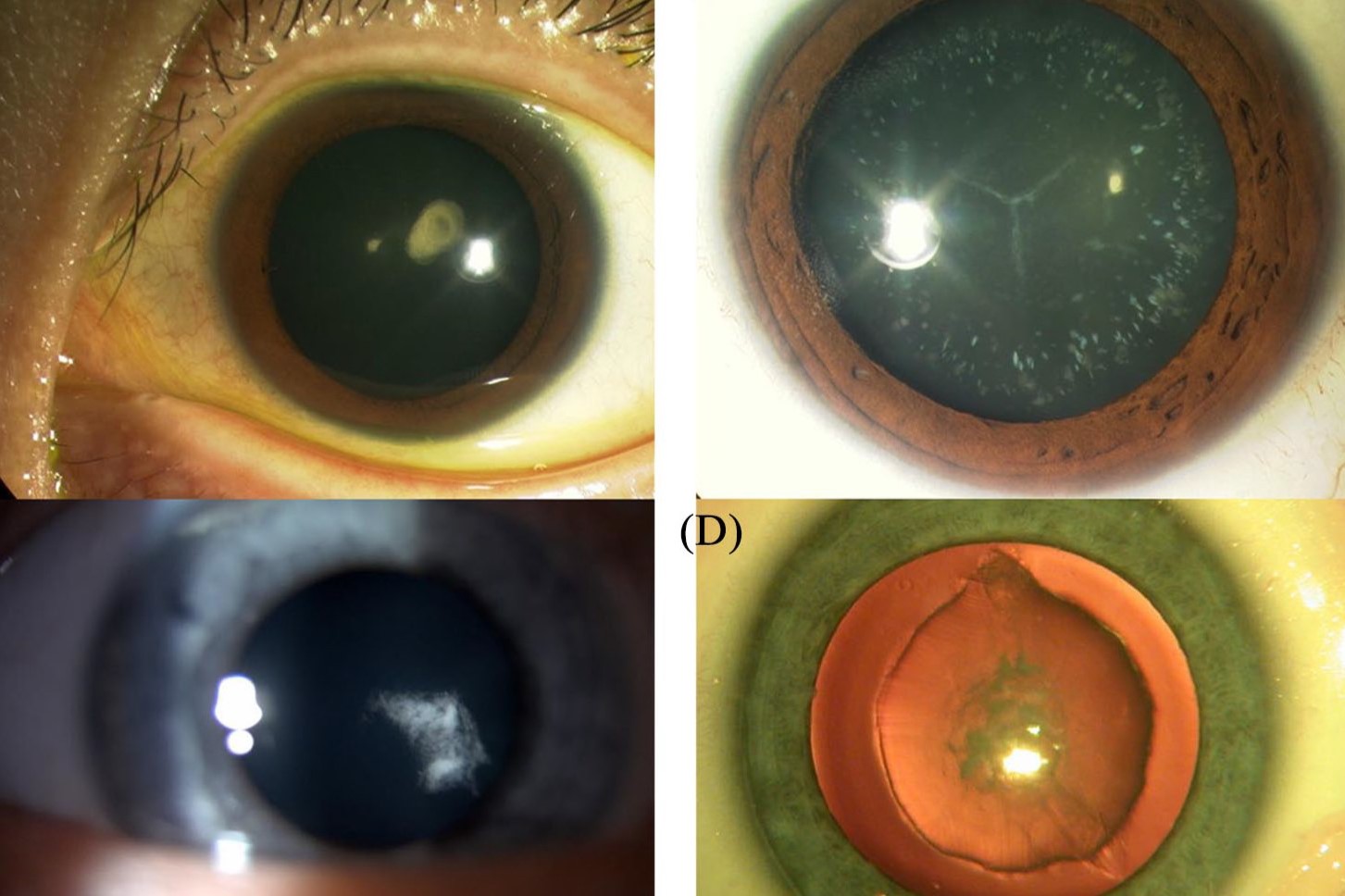 30-facts-about-myopathy-mitochondrial-cataract