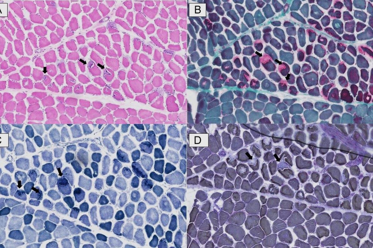 30-facts-about-myopathy-tubular-aggregates