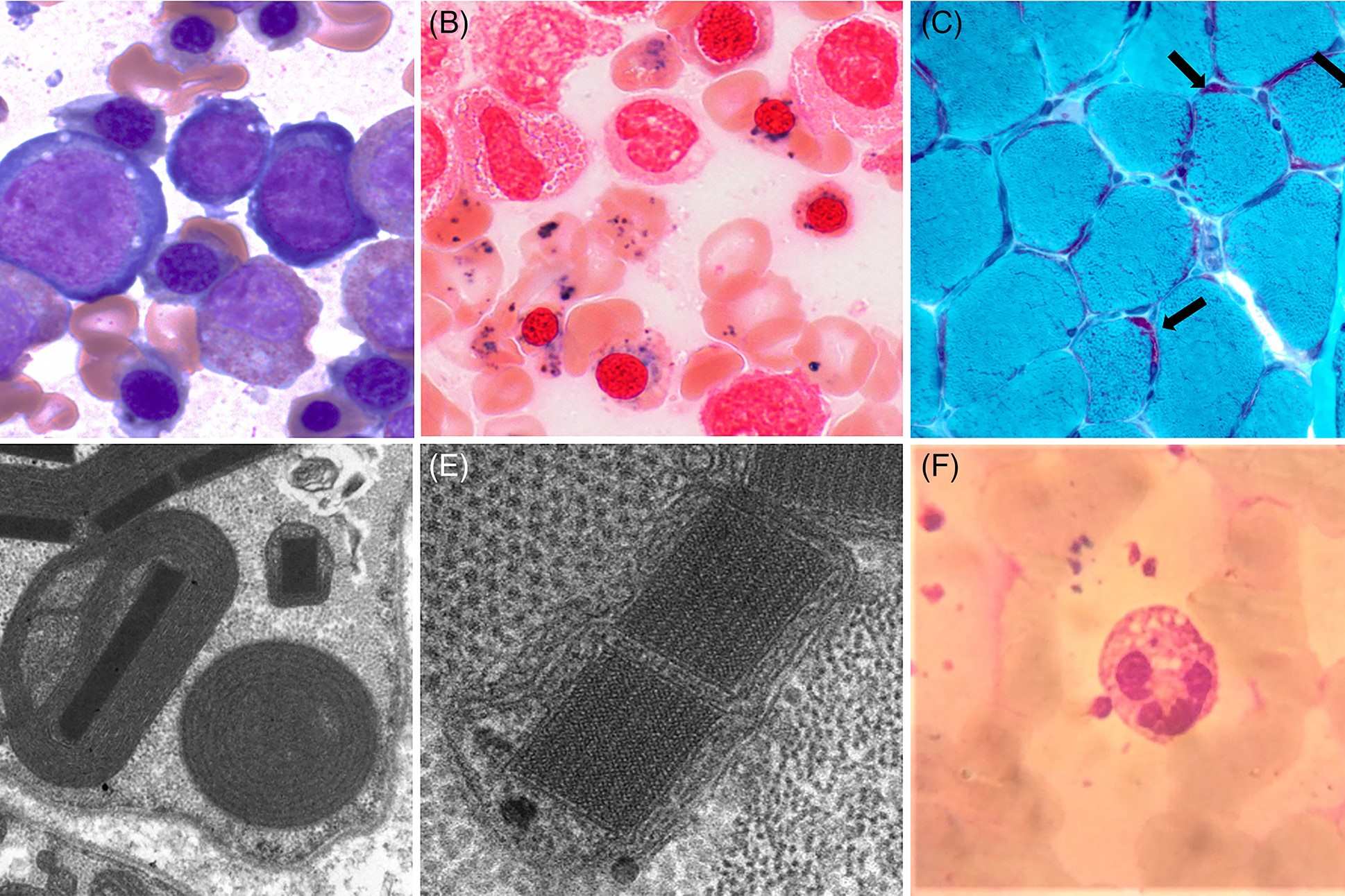 30-facts-about-myopathy-with-lactic-acidosis-and-sideroblastic-anemia