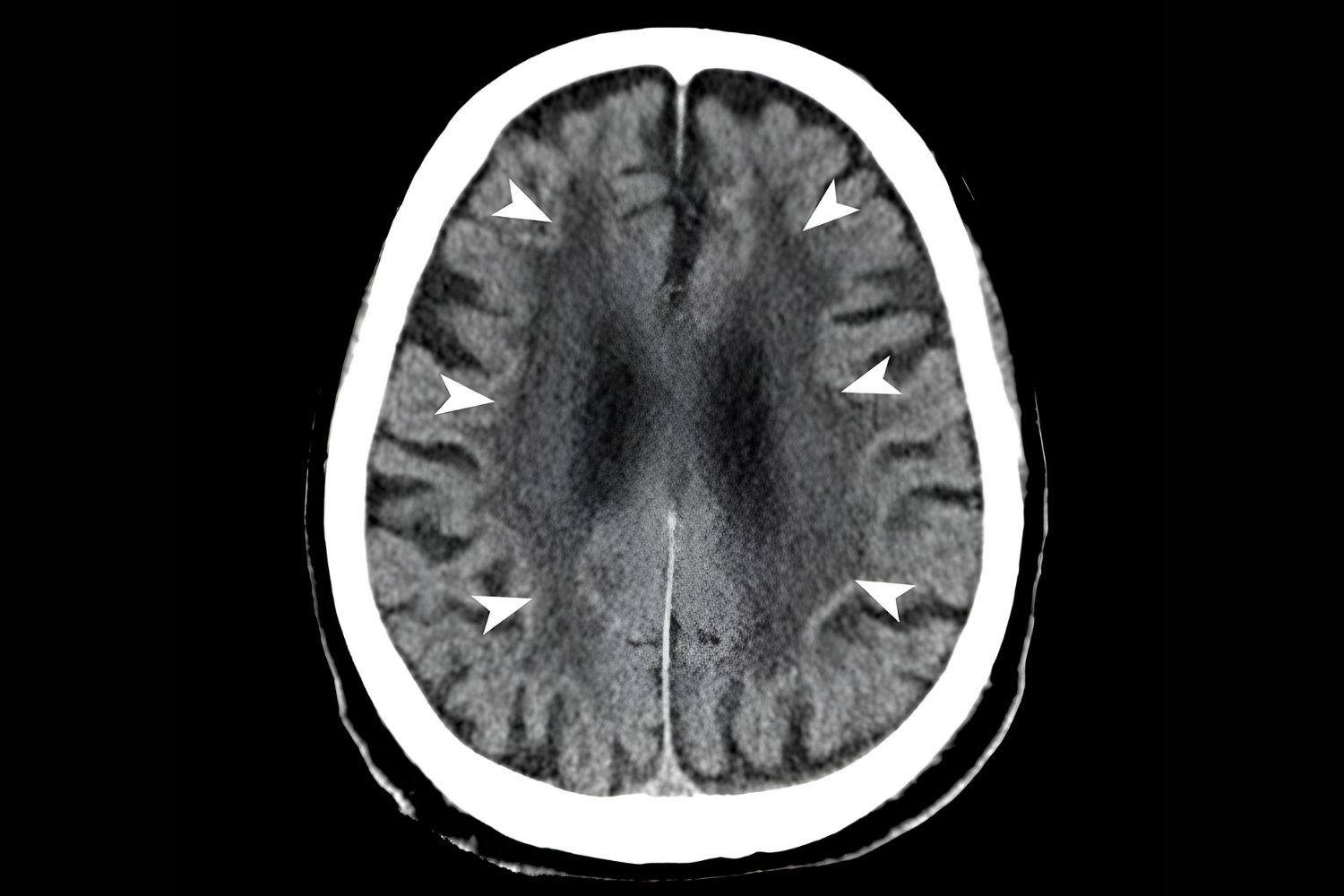 30-facts-about-neuronal-intranuclear-hyaline-inclusion-disease