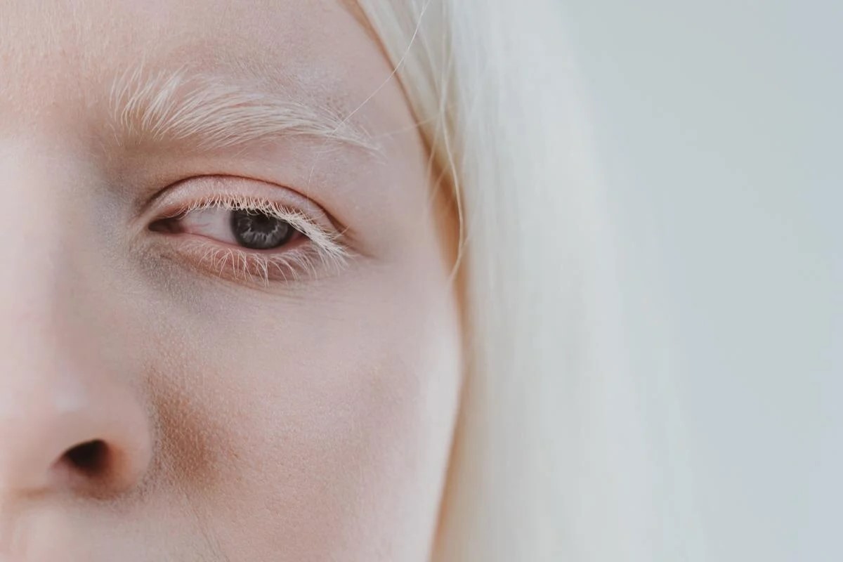 30-facts-about-oculocutaneous-albinism-immunodeficiency