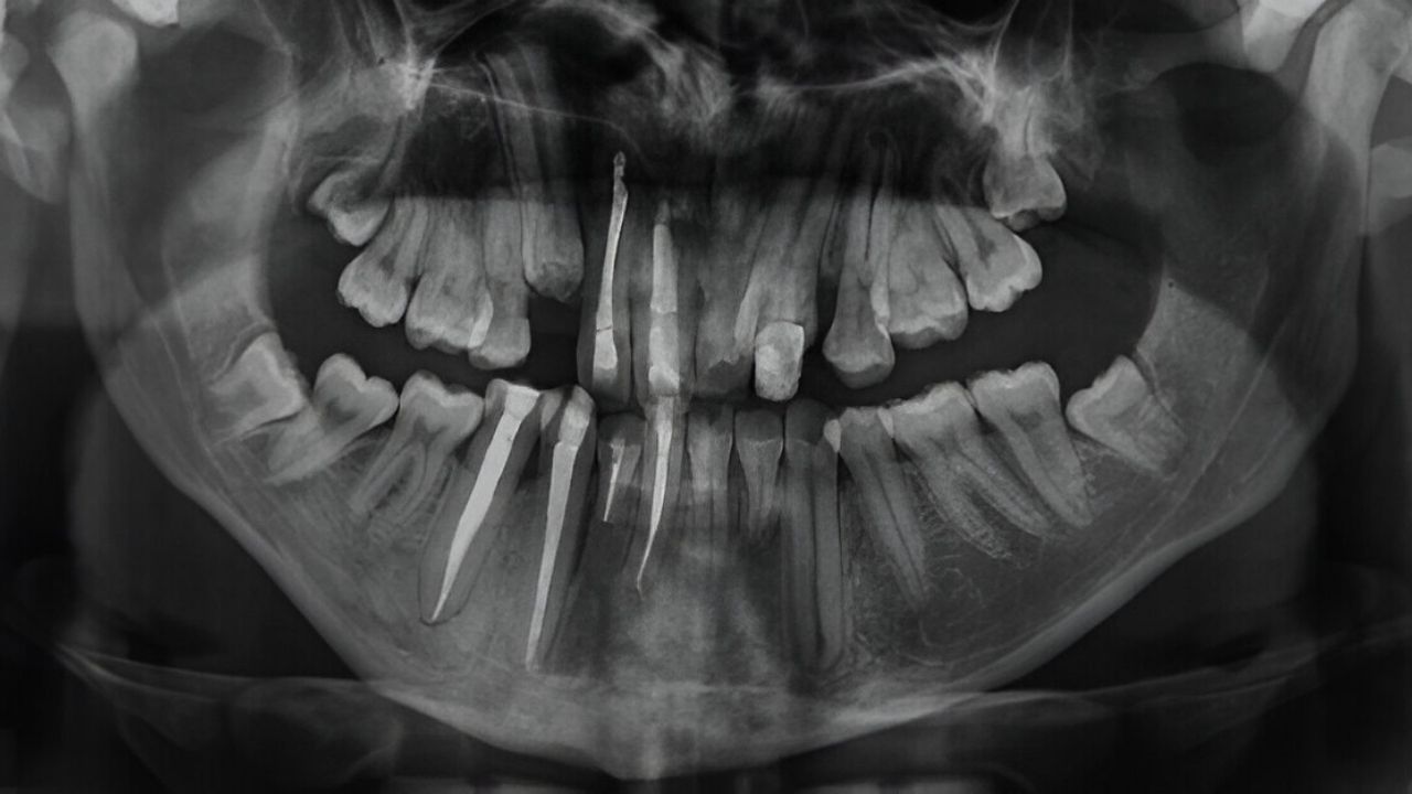 30-facts-about-radiculomegaly-of-canine-teeth-congenital-cataract