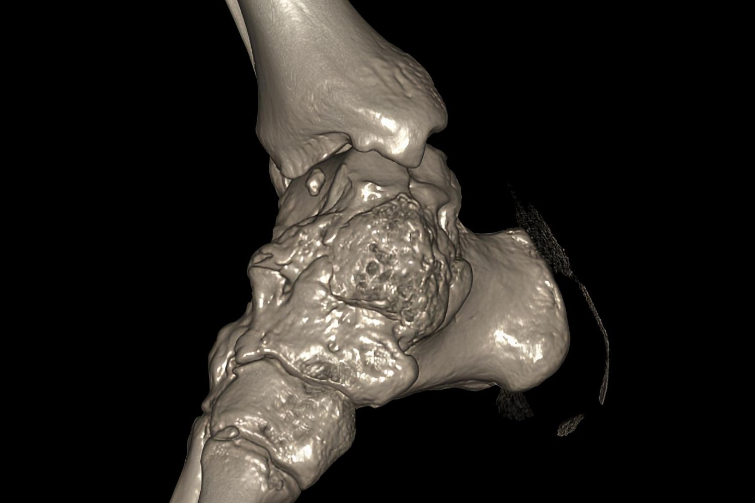 35-facts-about-dysplasia-epiphysealis-hemimelica