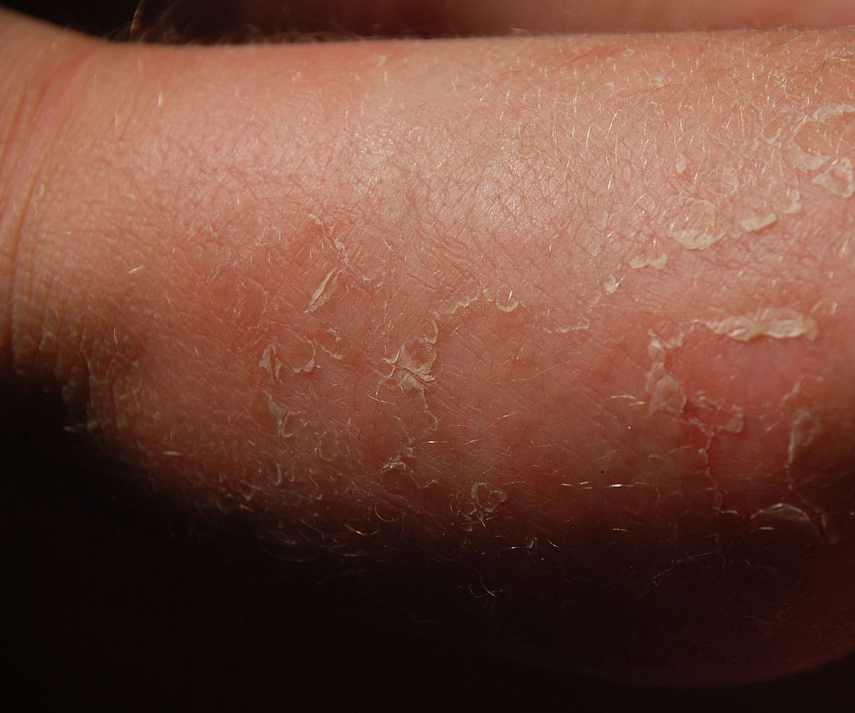 35-facts-about-ichthyosis-bullosa-of-siemens