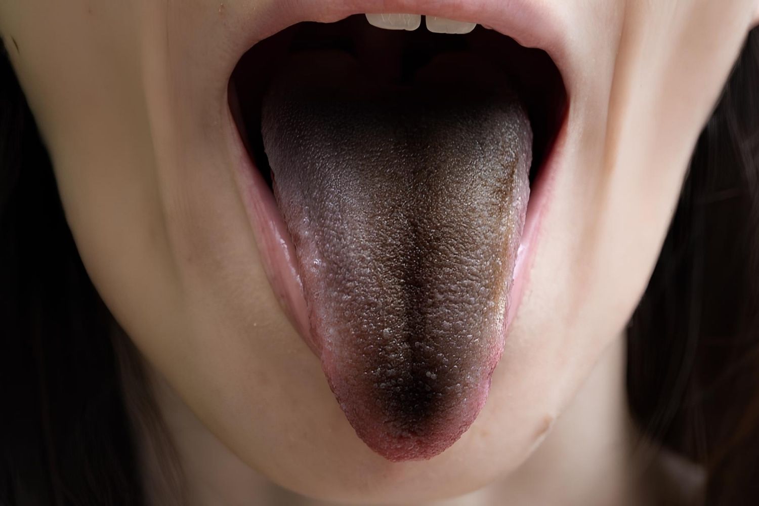 37-facts-about-black-hairy-tongue