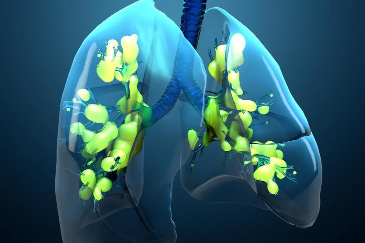 40-facts-about-acute-respiratory-distress-syndrome-ards