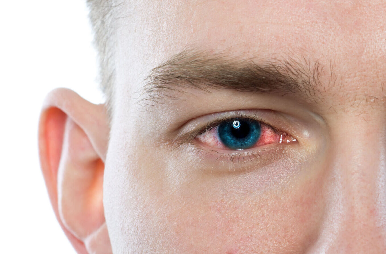 40-facts-about-gonococcal-conjunctivitis