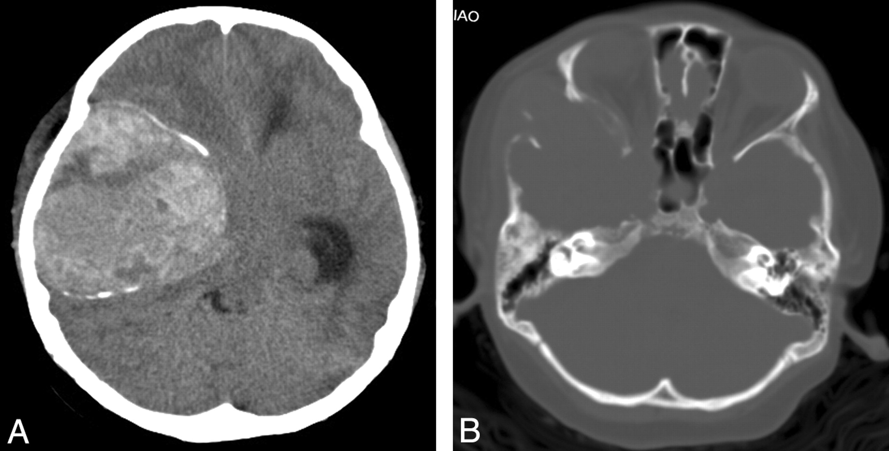 40-facts-about-hemangiopericytoma