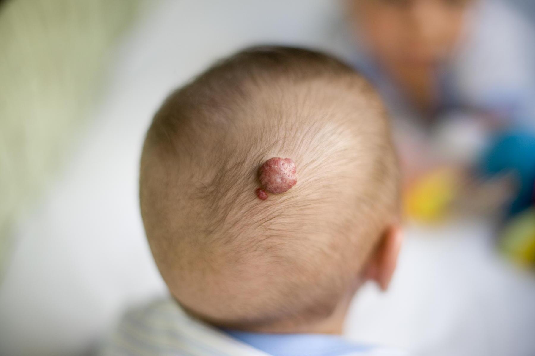 40-facts-about-infantile-hemangiomas