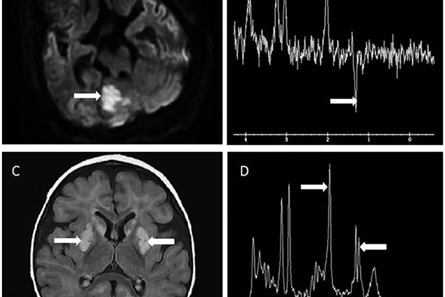 40-facts-about-myoneurogastrointestinal-encephalopathy