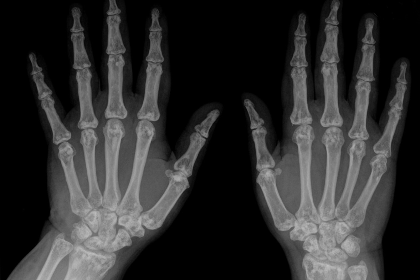 40-facts-about-osteopoikilosis