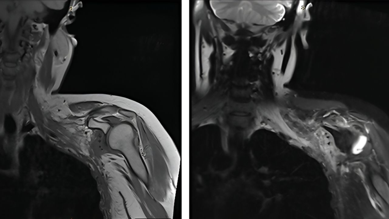 40-facts-about-radiation-induced-brachial-plexopathy