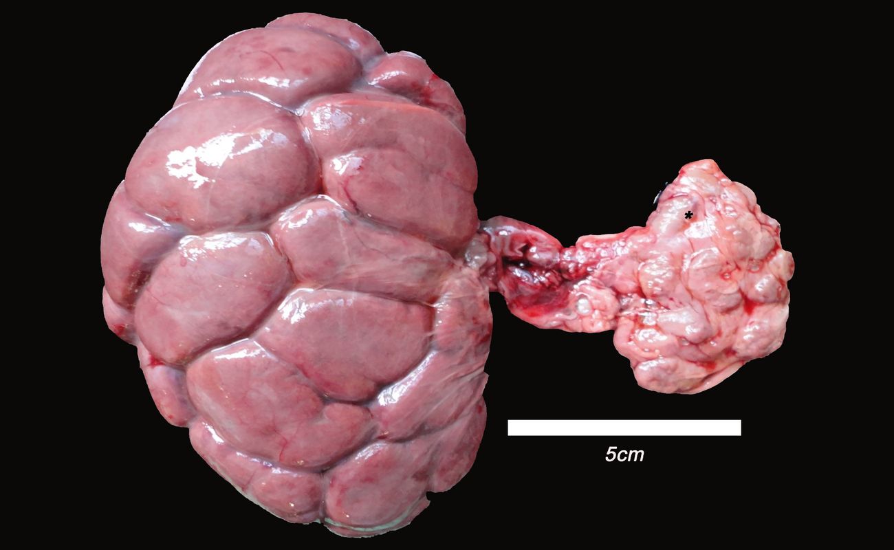 40-facts-about-renal-hypoplasia