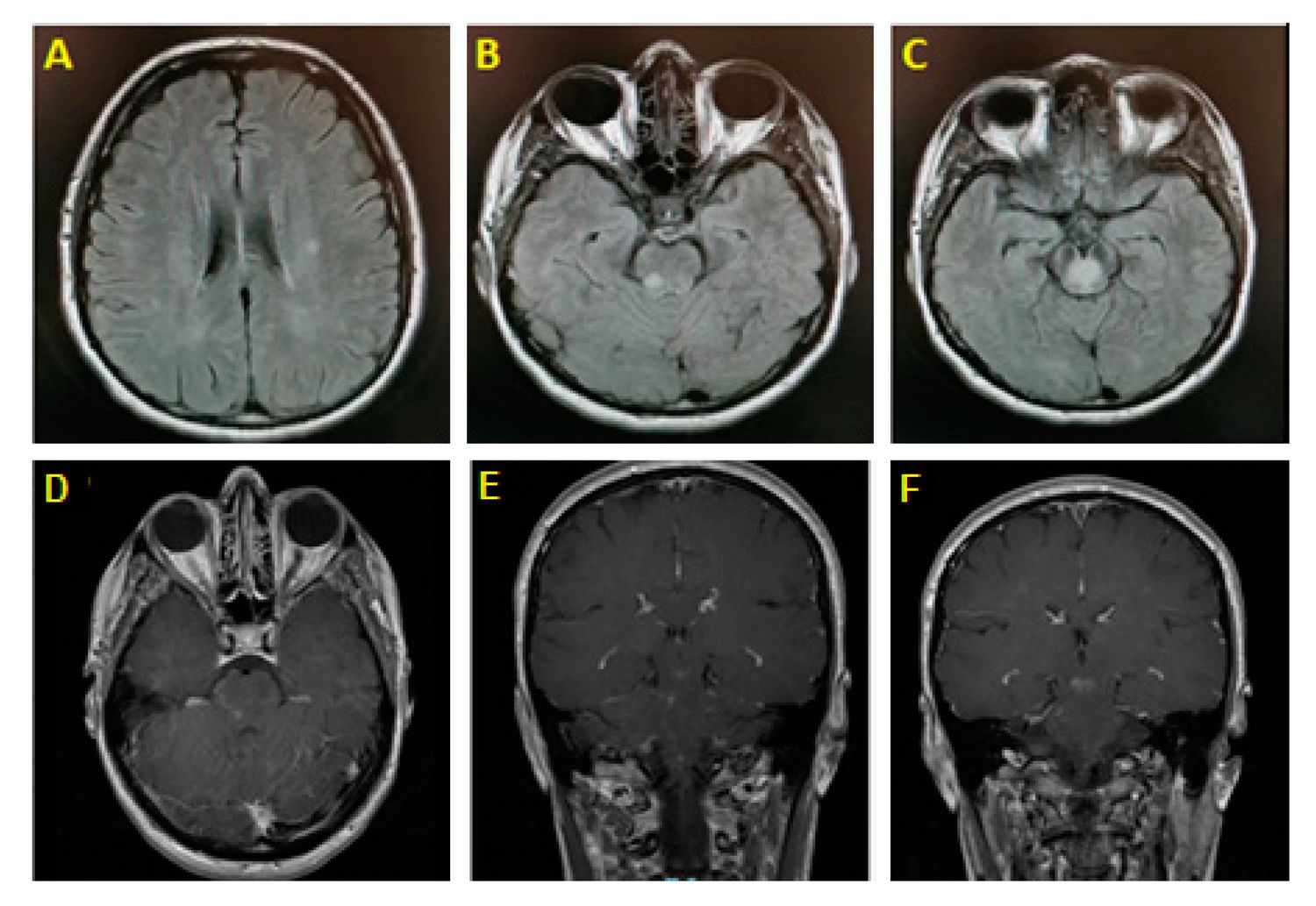 50-facts-about-bickerstaff-brainstem-encephalitis