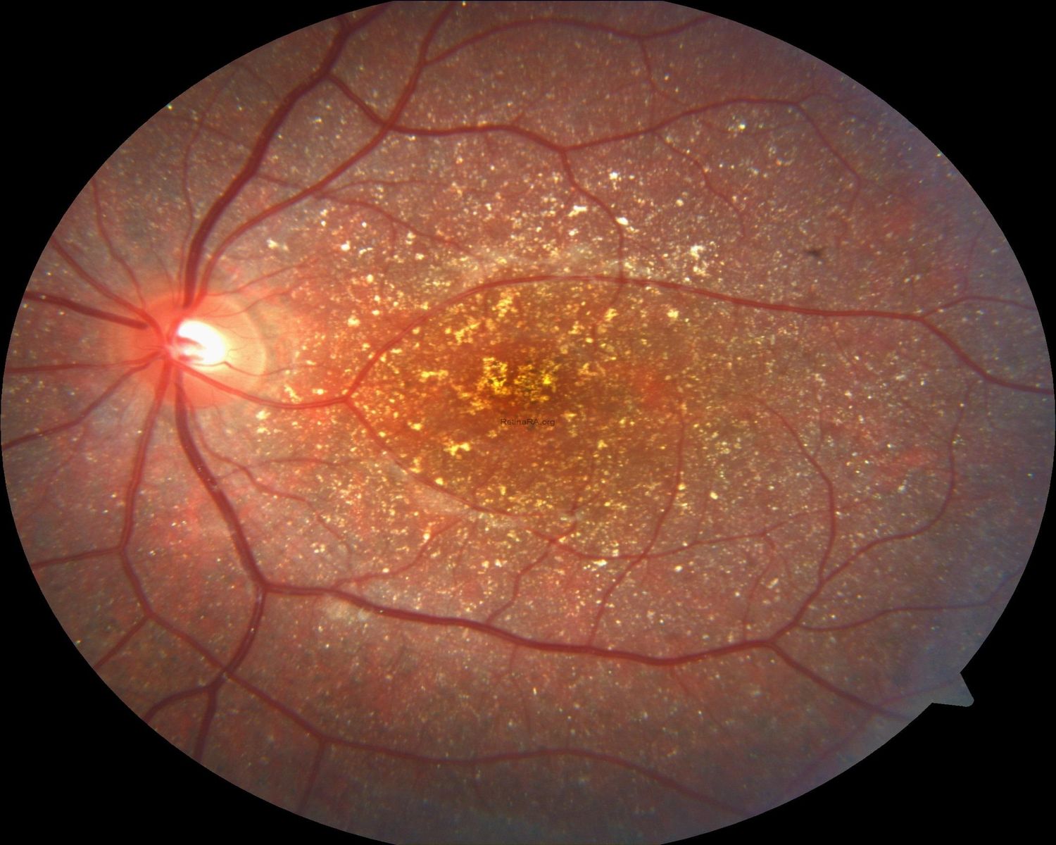 50-facts-about-bietti-crystalline-dystrophy