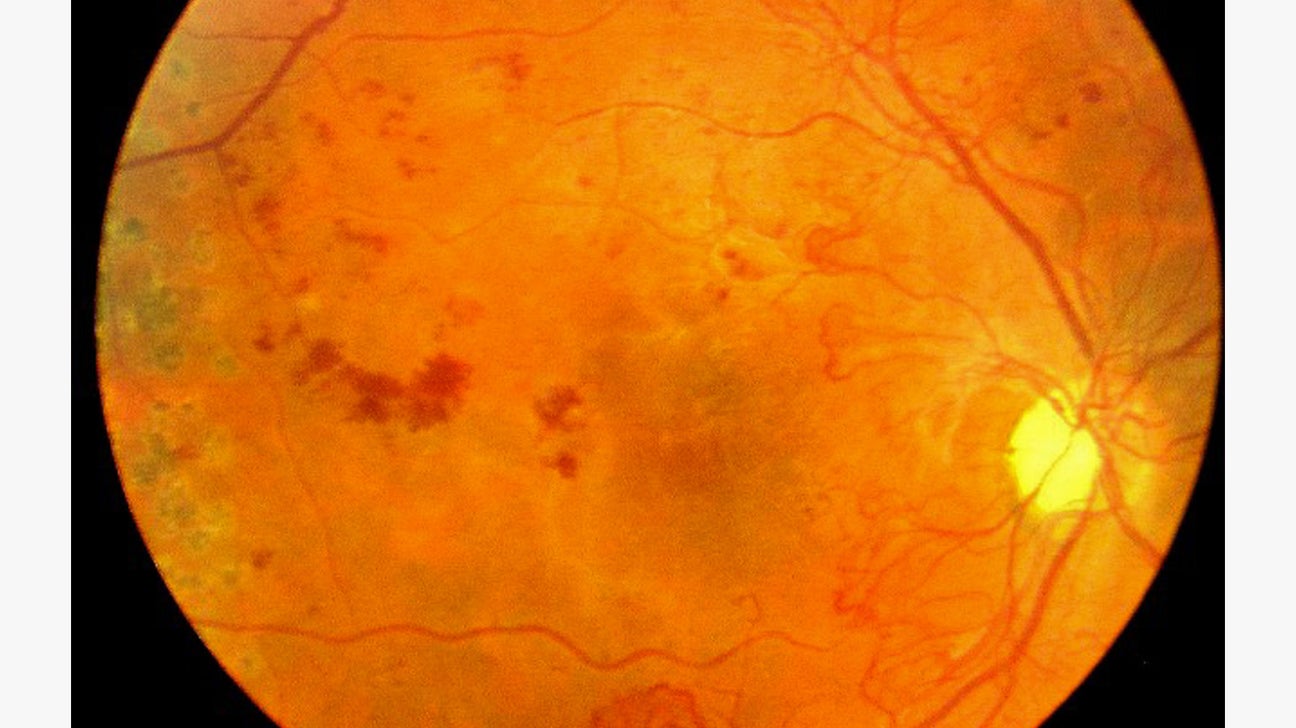 50-facts-about-diabetic-retinopathy