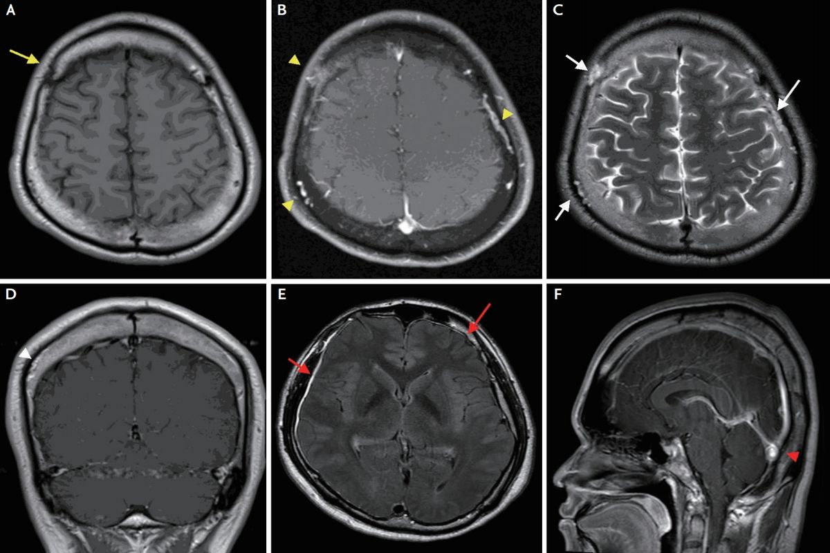 50-facts-about-gorhams-disease