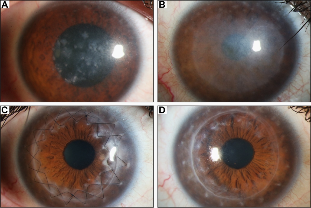 50-facts-about-hemihypertrophy-intestinal-web-corneal-opacity