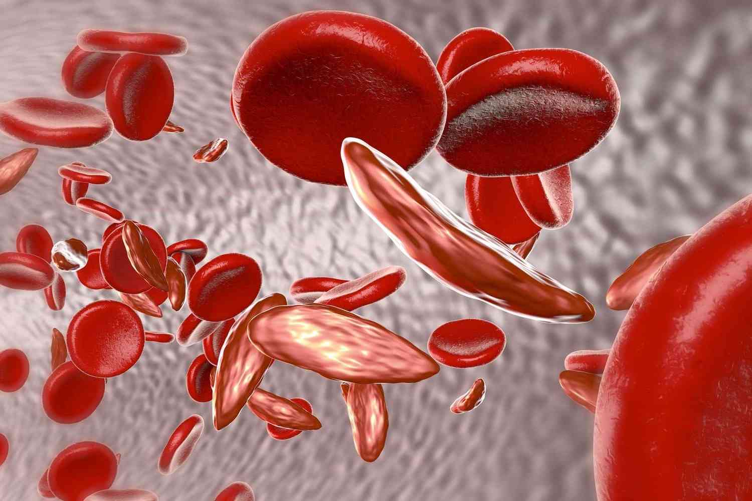 50-facts-about-hemoglobin-sc-disease