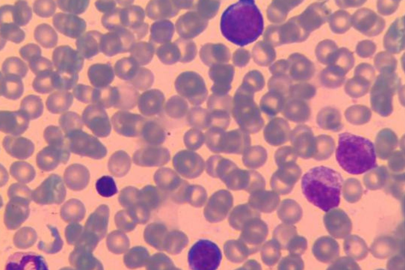 50-facts-about-hemolytic-anemia-lethal-genital-anomalies