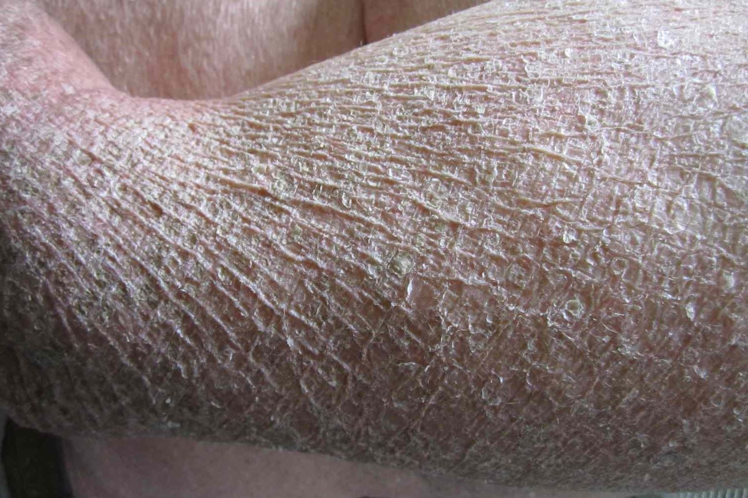 50-facts-about-ichthyosis-vulgaris