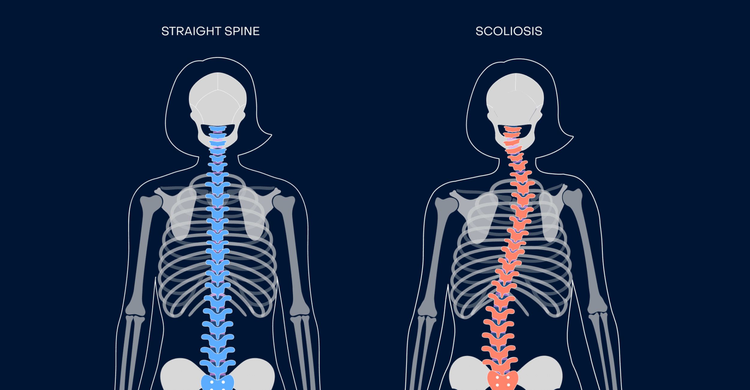 50-facts-about-idiopathic-adolescent-scoliosis