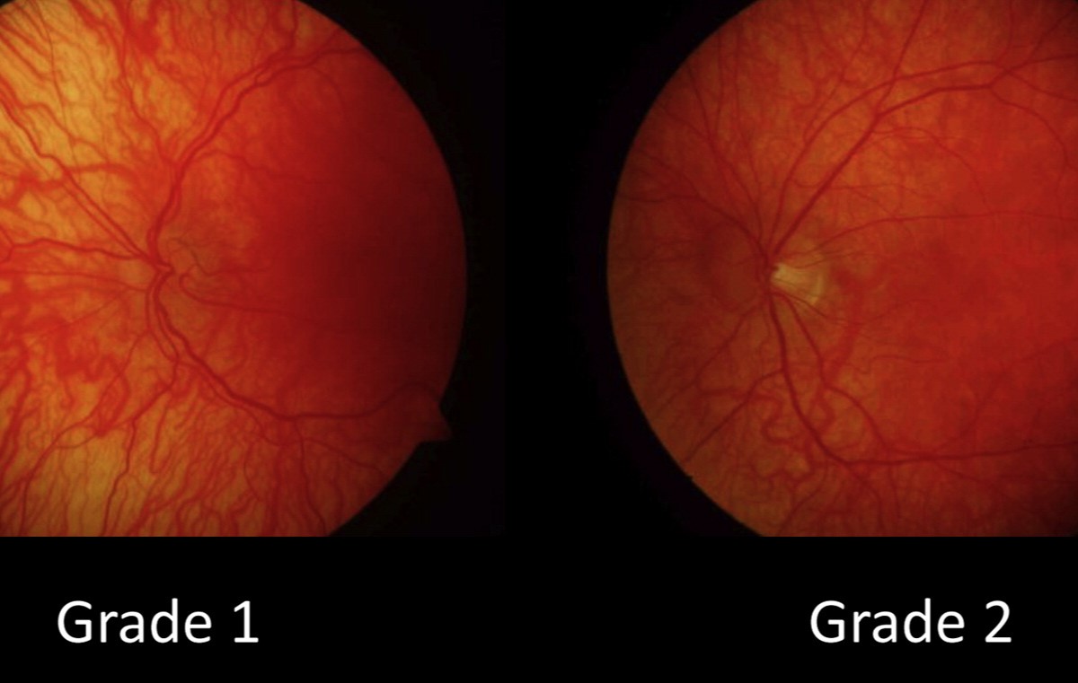 50-facts-about-idiopathic-congenital-nystagmus-icn