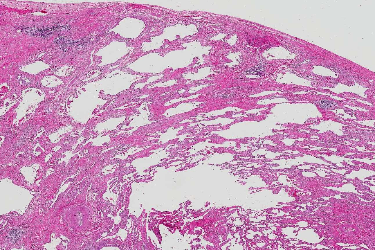 50-facts-about-idiopathic-diffuse-interstitial-fibrosis