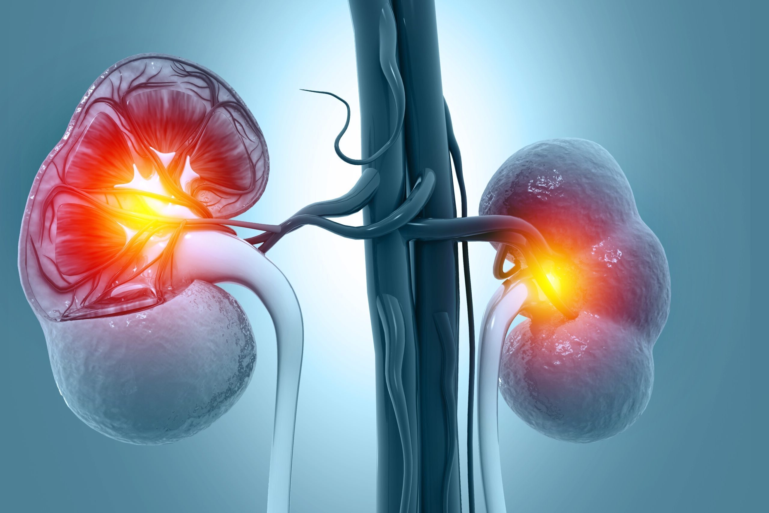 50-facts-about-iga-nephropathy