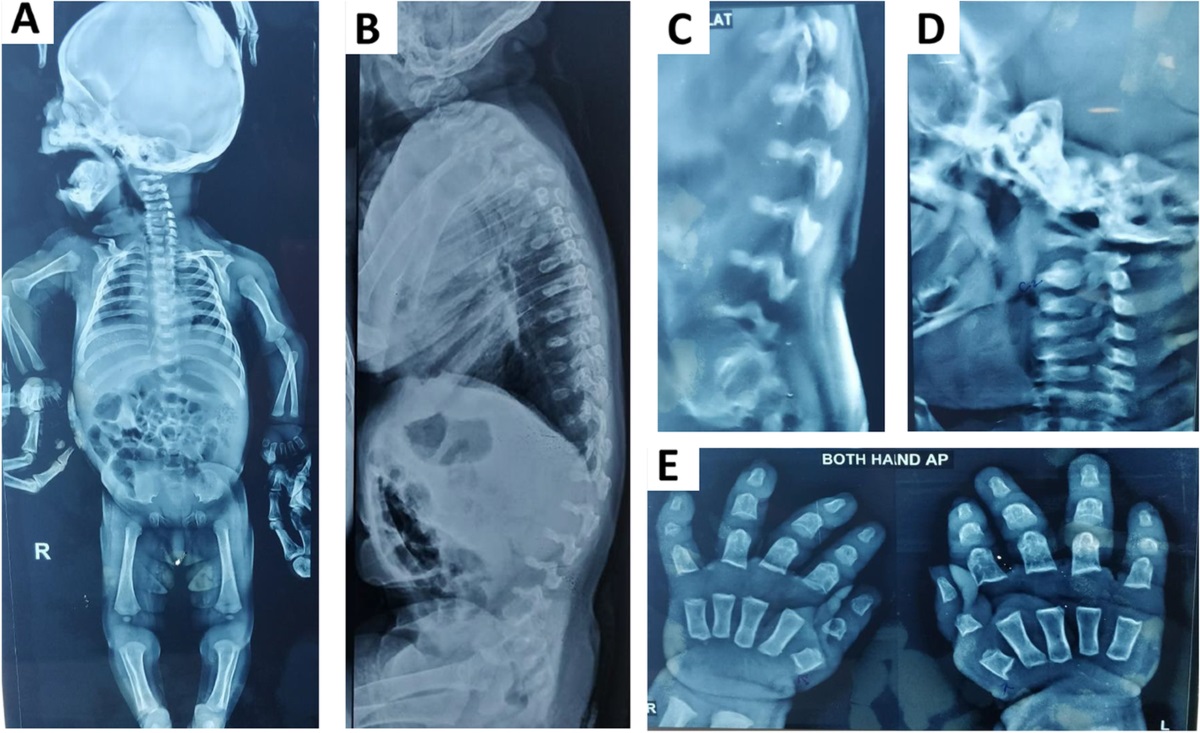 50-facts-about-immunodeficiency-with-short-limb-dwarfism