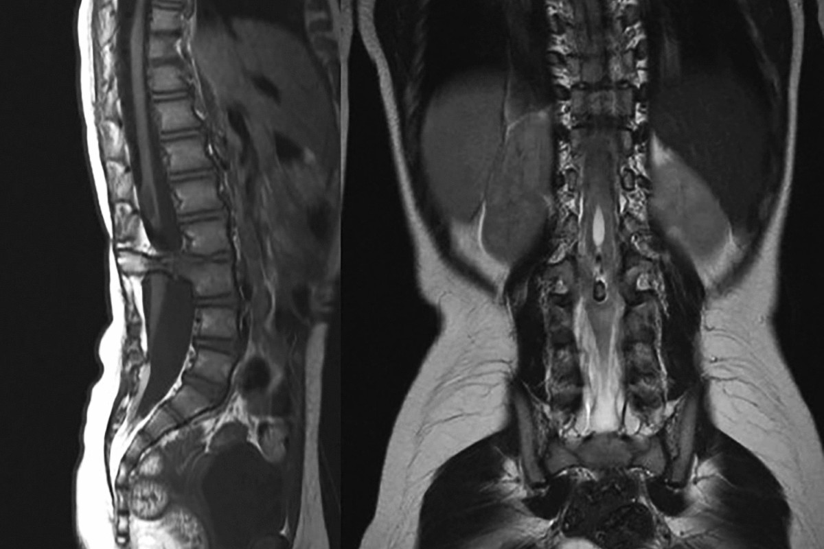 50-facts-about-imperforate-oropharynx-costo-vertebral-anomalies