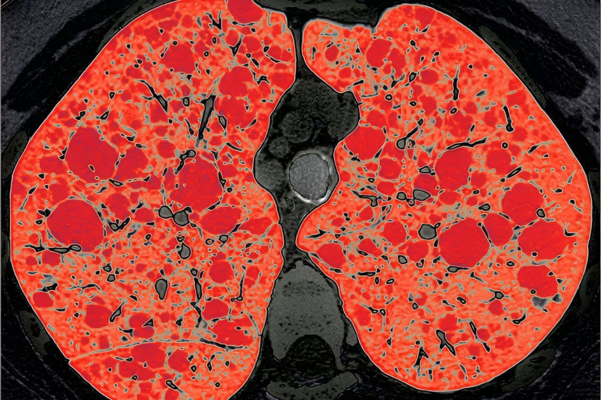 50-facts-about-lymphangioleiomyomatosis