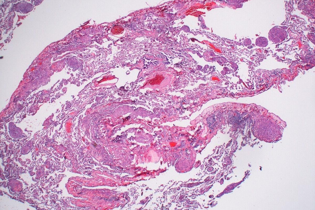 50-facts-about-lymphangiomyomatosis