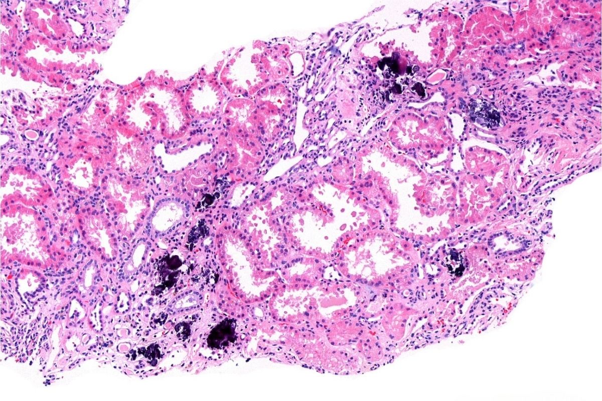 50-facts-about-nephrocalcinosis