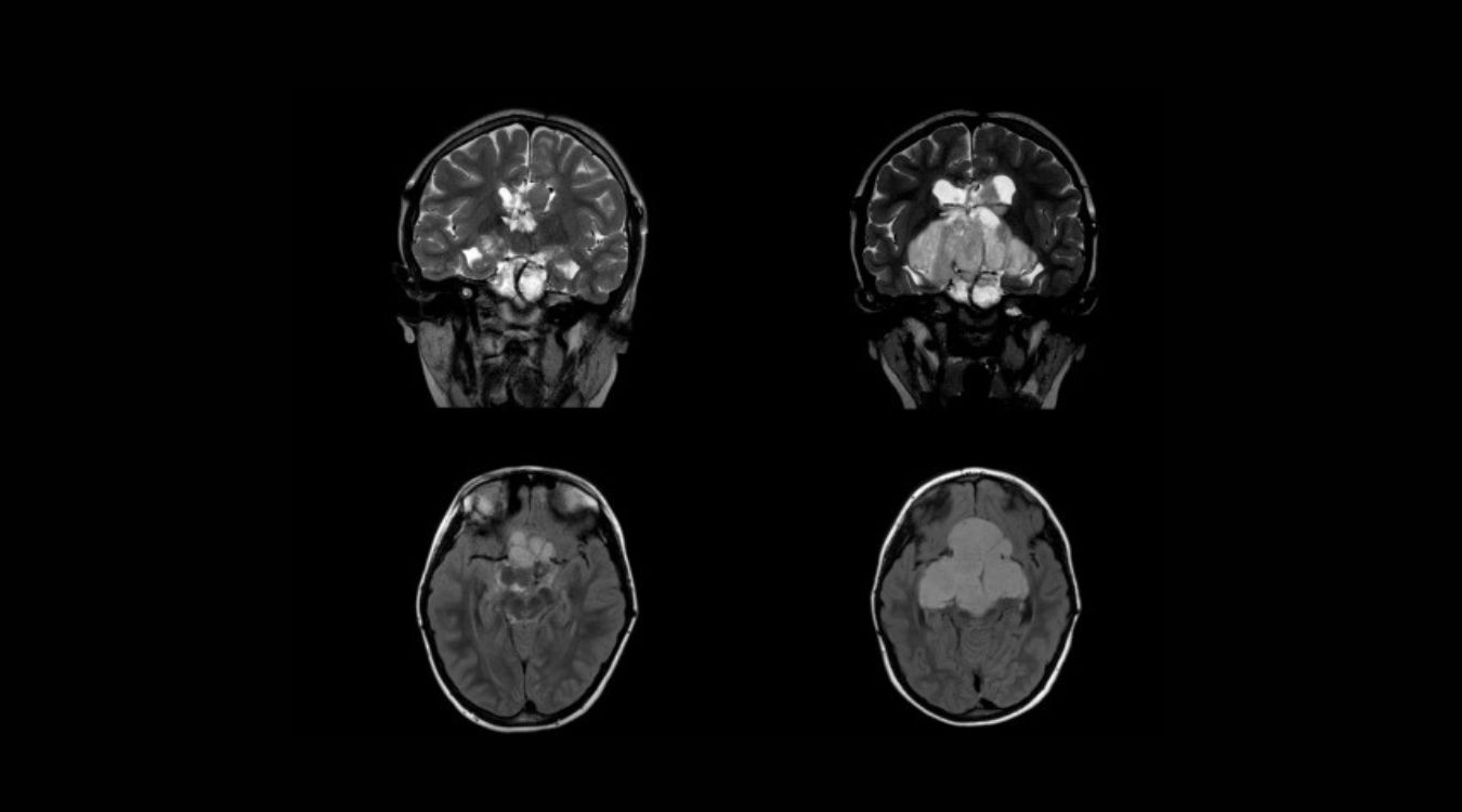 50-facts-about-optic-pathway-glioma