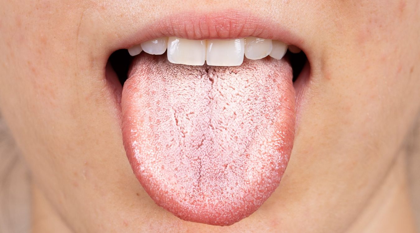 50-facts-about-oral-leukoplakia